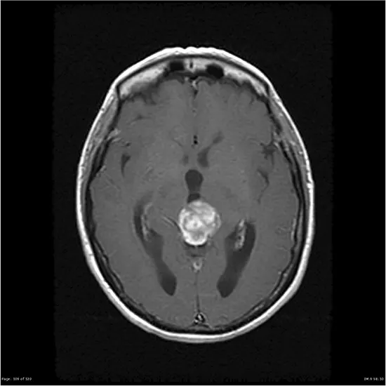 pineal astrocytoma